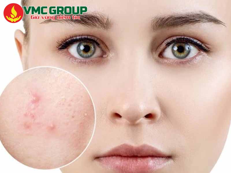Acid citric trong mỹ phẩm có tác dụng hỗ trợ điều trị mụn